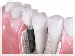 Representation of a dental implant